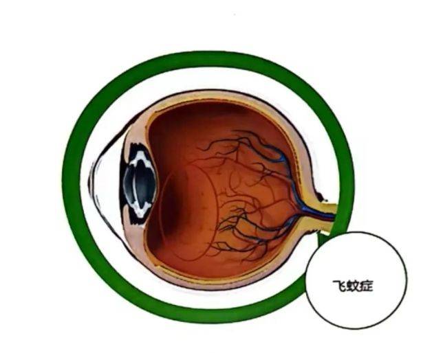 飛蚊癥治療最新突破，開(kāi)啟視界新篇章
